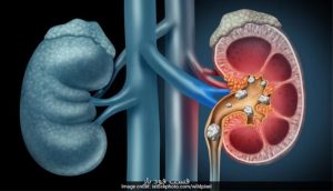 عضو هیئت علمی پژوهشگاه رویان مطرح کرد تشخیص ژنتیکی بیماری کلیه پلی کیستیک اتوزومال غالب