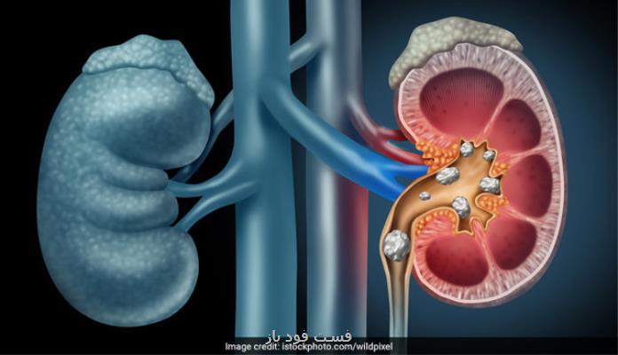 عضو هیئت علمی پژوهشگاه رویان مطرح کرد تشخیص ژنتیکی بیماری کلیه پلی کیستیک اتوزومال غالب