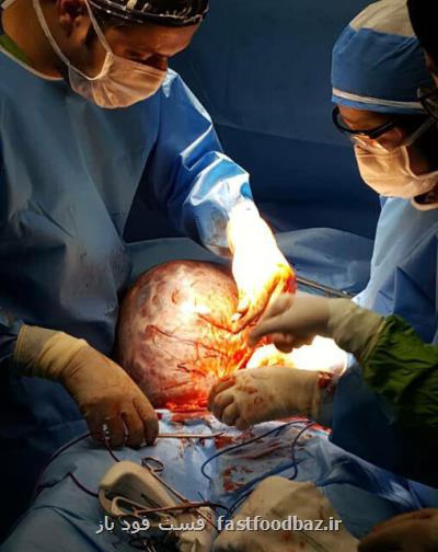 توده ۸ کیلویی از شکم بانوی ساوجی خارج شد