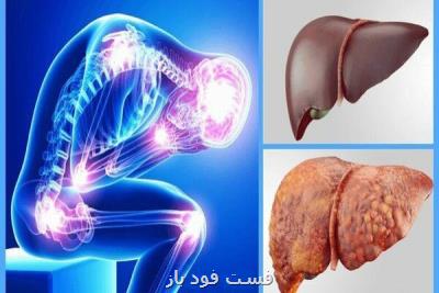 کبد چرب شایع ترین علت پیوند کبد تا سال ۲۰۳۰