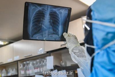 مشکلات تنفسی در بهبود یافتگان کووید- ۱۹ ماندگار است؟