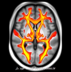 محققان دانشگاه آکسفورد مطرح کردند فشار خون بالا و دیابت در میانسالی ساختار مغز را تغییر می دهد