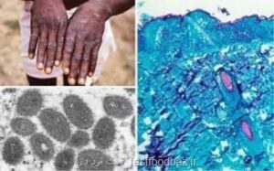 آبله میمون: زمانی برای نگرانی یا نادیده انگاری؟