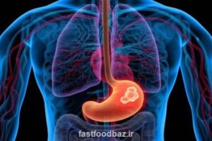 چند یادآوری مهم برای جلوگیری از سرطان معده