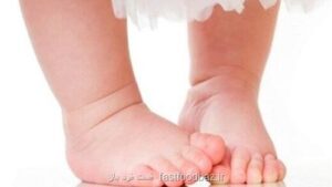 شایع ترین علت پای پرانتزی در کودکان