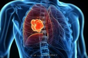 چند سفارش برای جلوگیری از سرطان ریه