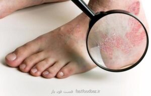 مطالعات نشان می دهد؛ مبتلایان به پسوریازیس شدید در معرض خطر بیشتر بیماری قلبی هستند