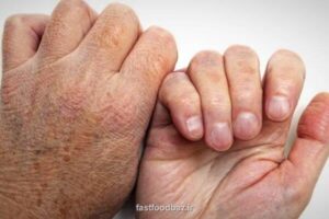 ناصحی عنوان كرد؛ شیوع جذام در کشور کذب است