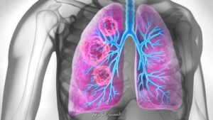 محققان هلندی پی بردند؛ خیلی از افراد غیرسیگاری گره های ریوی در رابطه با خطر سرطان دارند