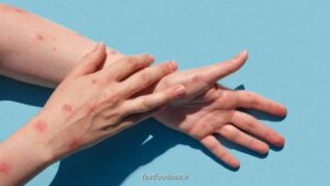 دبیر انجمن بررسی و مطالعه درد در ایران : بیماری زونا مسری نیست