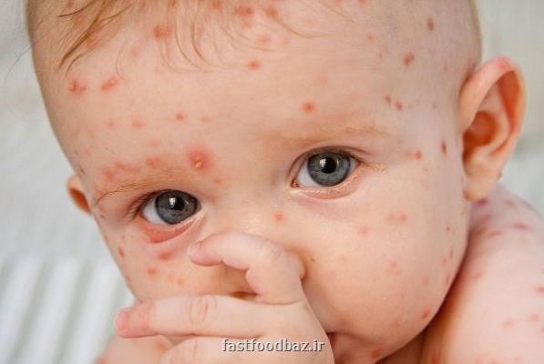 ابتلای کودکان به آبله مرغان خطرناک نیست
