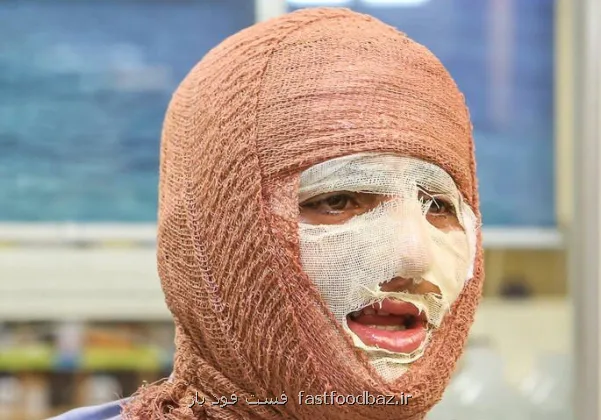 سوختگی لطمه جسمی و روانی که فراتر از درمان است